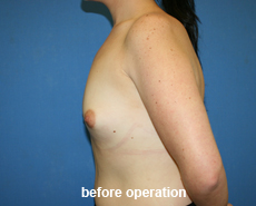 plastic-surgery-breast-augmentation